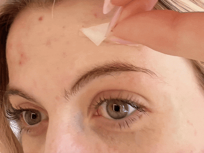 REVELA™ Hydrocolloid Roll For Acne and Scarring