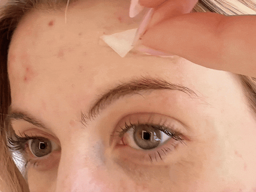 REVELA™ Hydrocolloid Roll For Acne and Scarring